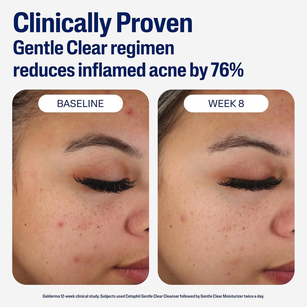 Cetaphil Gentle Clear Mattifying Acne Face Moisturizer, Salicylic Acid, 3oz | Salicylic Acid Moisturizer, Non-Comedogenic, Hydrates Sensitive Acne-Prone Skin, Oil Control, Gentle Skincare, 3 oz