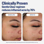Cetaphil Gentle Clear Mattifying Acne Face Moisturizer, Salicylic Acid, 3oz | Salicylic Acid Moisturizer, Non-Comedogenic, Hydrates Sensitive Acne-Prone Skin, Oil Control, Gentle Skincare, 3 oz