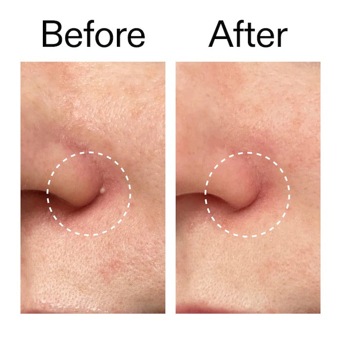 THE INKEY LIST - Hydrocolloid Invisible Pimple Patches - 22 Patches - Image 2