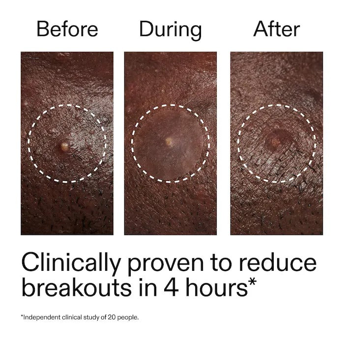 THE INKEY LIST - Hydrocolloid Invisible Pimple Patches - 22 Patches - Image 3