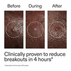 THE INKEY LIST - Hydrocolloid Invisible Pimple Patches - 22 Patches - Image 3
