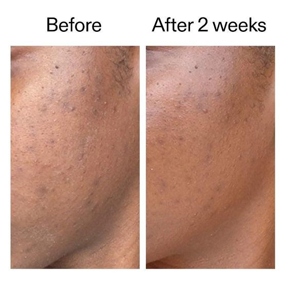 The INKEY List - 360 Acne Clearing Serum with Dioic & Salicylic Acid - 30ml - Image 3