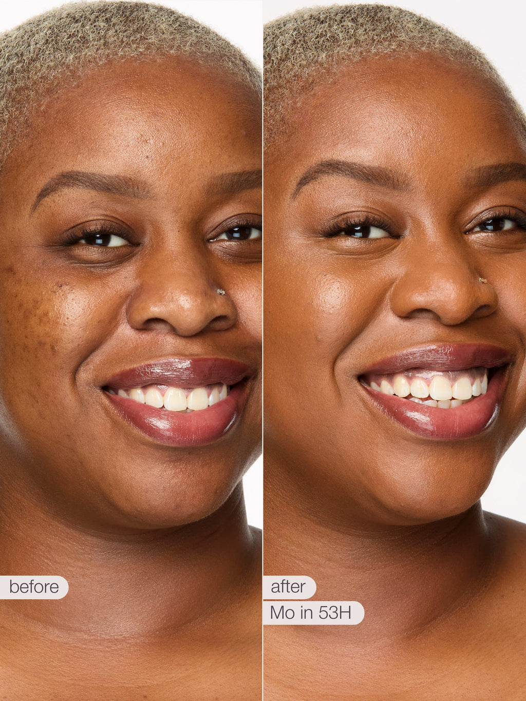Before and after comparison of a woman's smile with visible skin improvement.