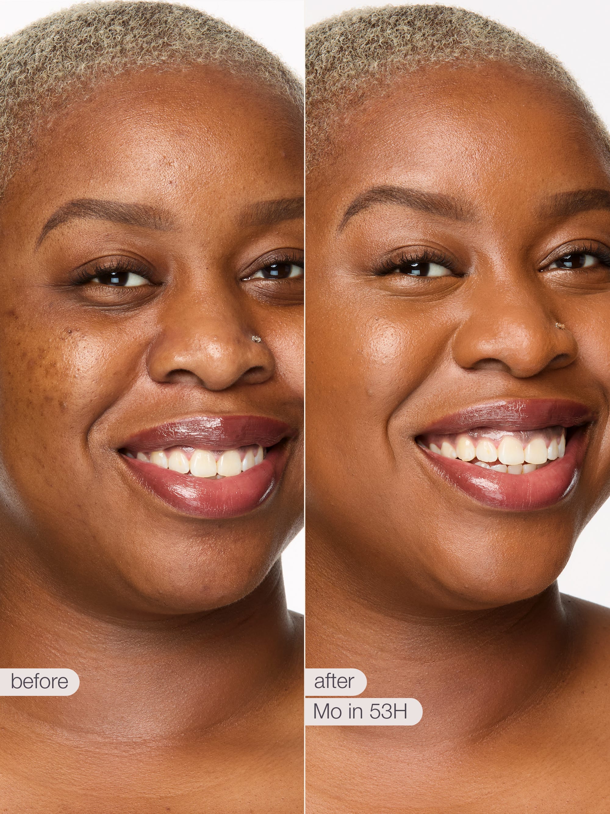 Before and after comparison of a woman's smile with visible skin improvement.